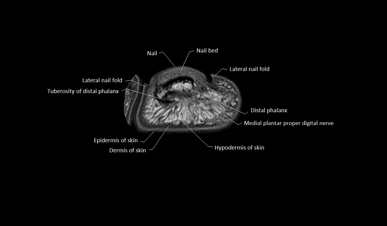 Great toe (hallux) axial microanatomy 3T MRI image 6.webp